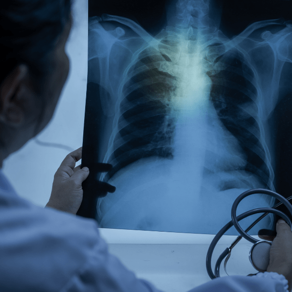 A doctor looks at an xray of the lungs